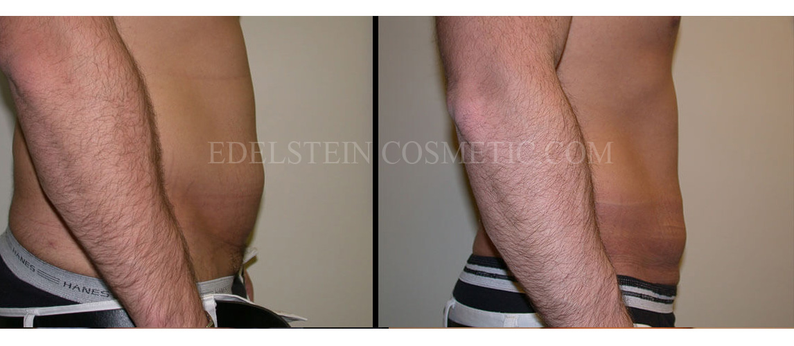 liposcution-toronto-before-after-p02