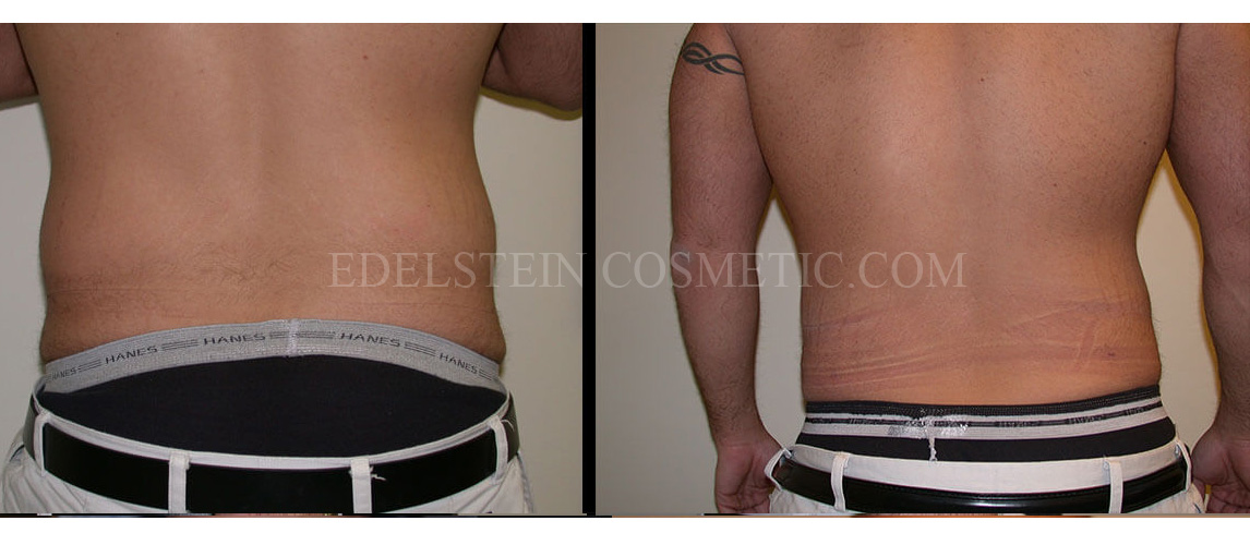 liposcution-toronto-before-after-p02a