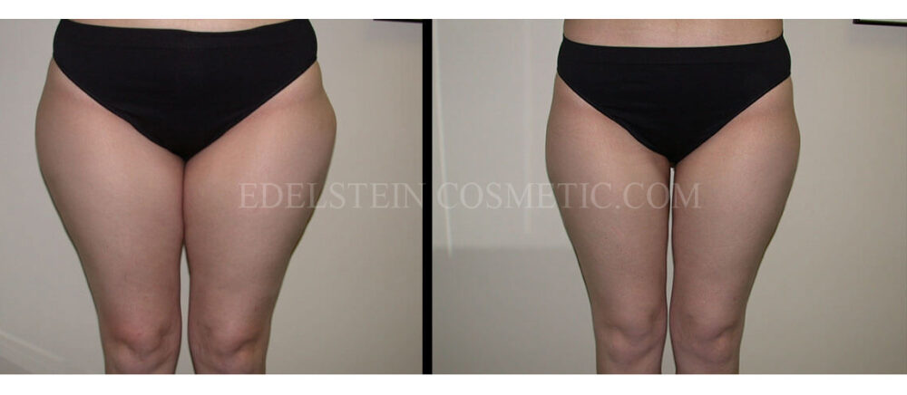 Liposuction case #26588