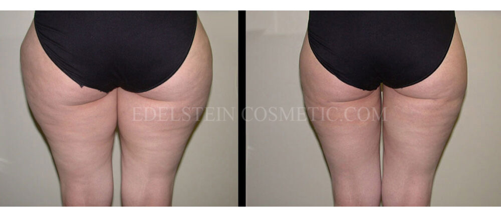 Liposuction case #26588