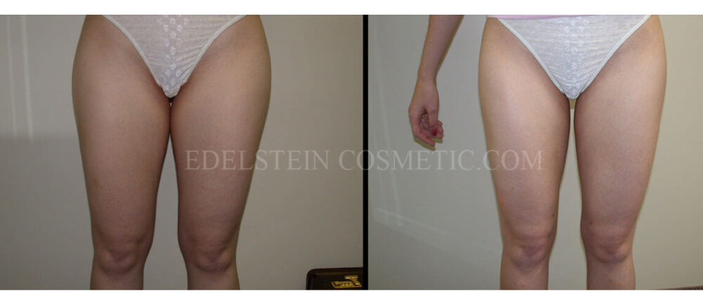 Liposuction case #26587