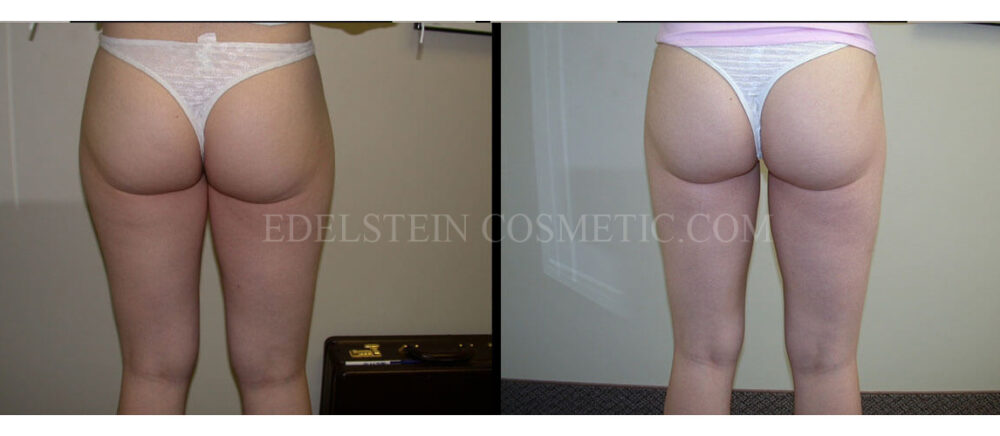 Liposuction case #26587