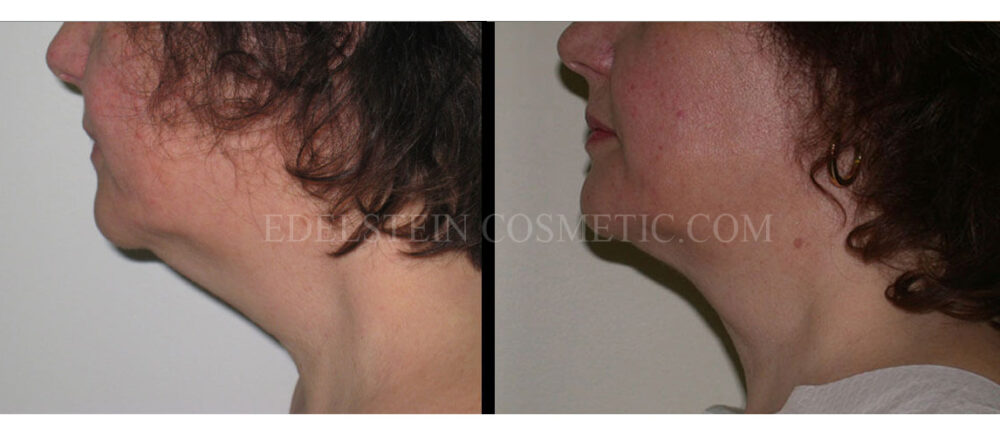 Liposuction case #26585