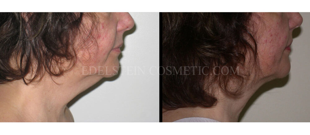 Liposuction case #26585