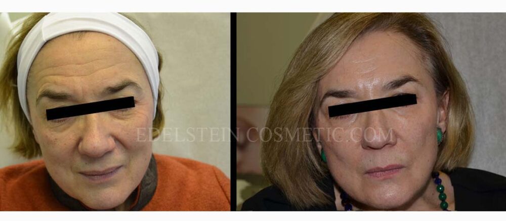 Liquid Facelift/SoftLift case #26743