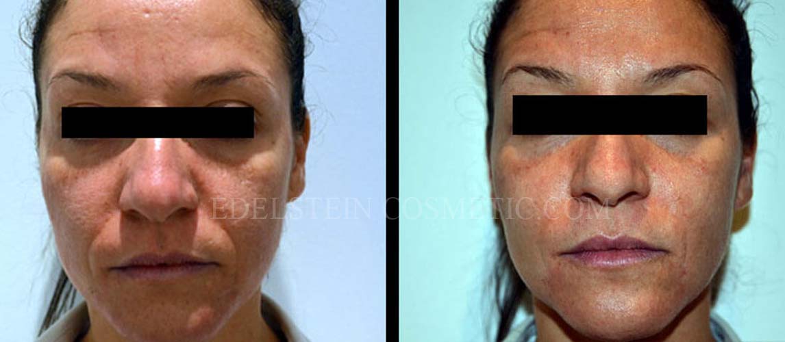 Liquid Facelift/SoftLift case #26742