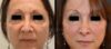 Liquid Facelift/SoftLift case #26741 slider thumbnail