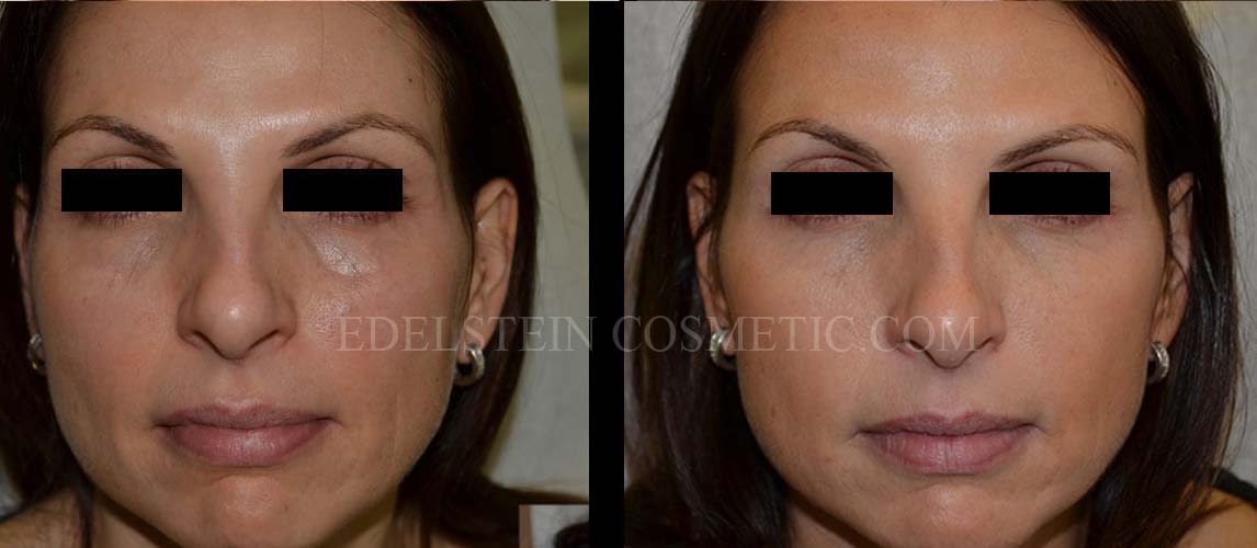 Liquid Facelift/SoftLift case #26739