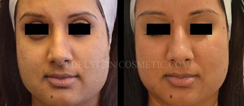 Microneedling case #26746