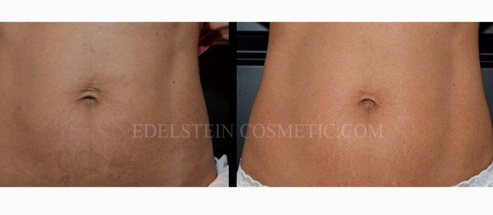 Microneedling case #26747