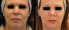 Photofacial Rejuvenation case #26748 slider thumbnail