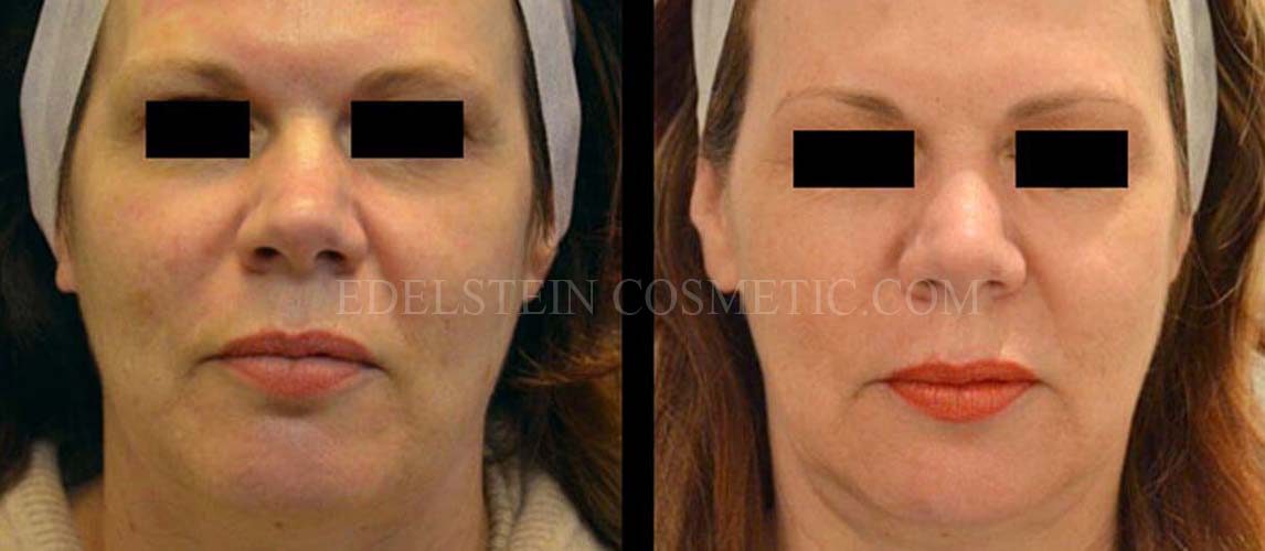 photofacial-rejuvenation-toronto-before-after-p01