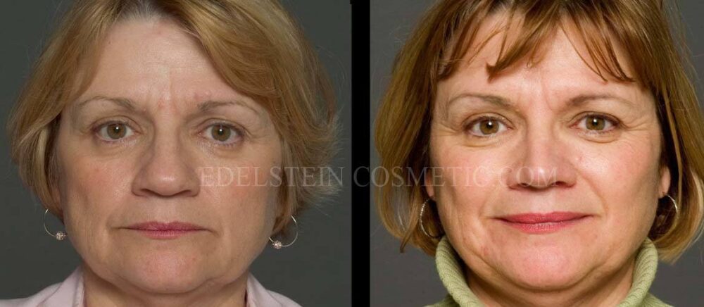 Primary Rhinoplasty case #26771