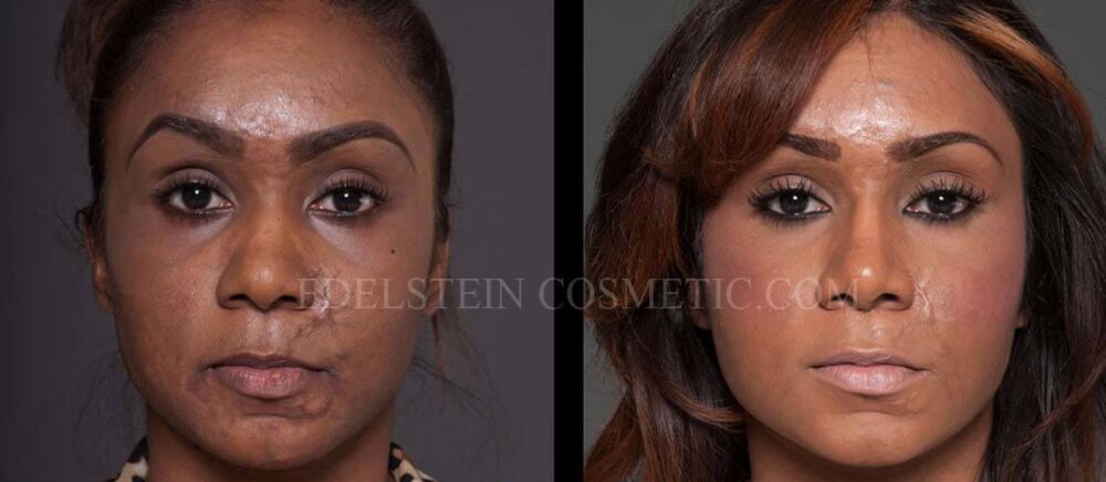 Primary Rhinoplasty case #26779