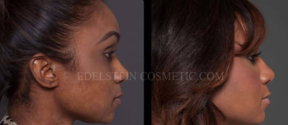 Primary Rhinoplasty case #26779