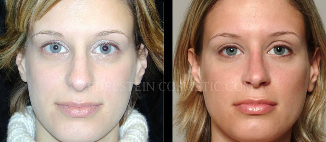 Primary Rhinoplasty case #26781