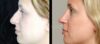 Primary Rhinoplasty case #26781 slider thumbnail