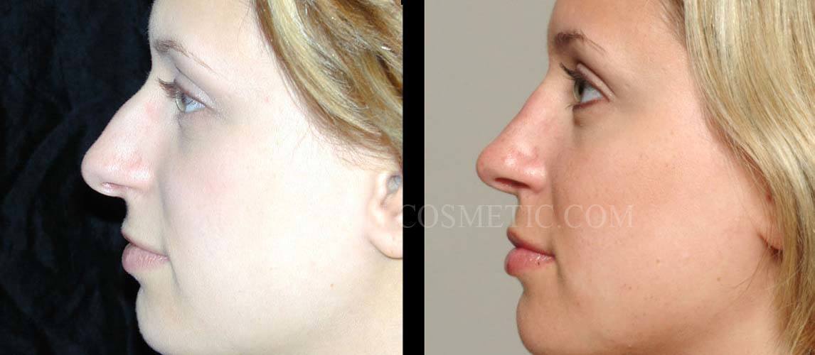 Primary Rhinoplasty case #26781