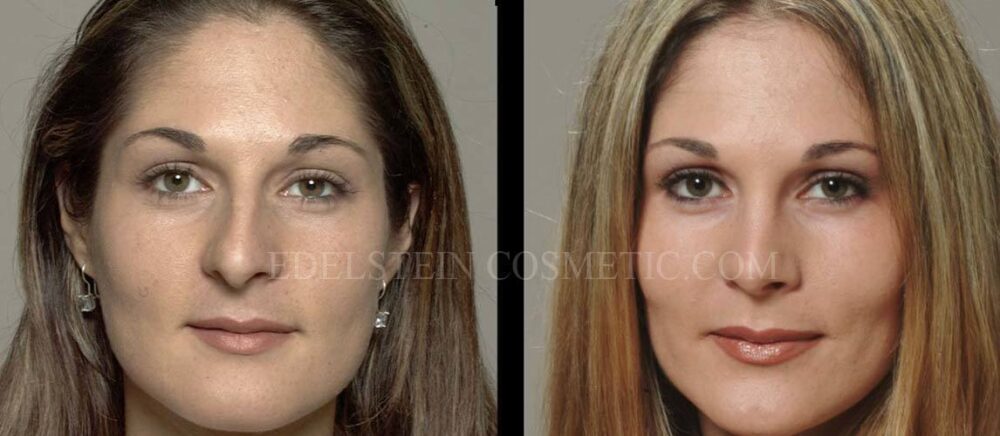 Primary Rhinoplasty case #26767