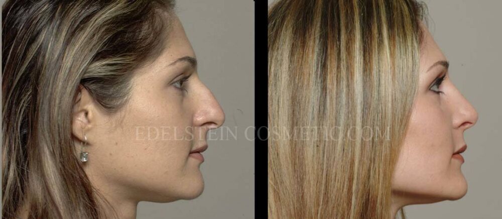 Primary Rhinoplasty case #26767