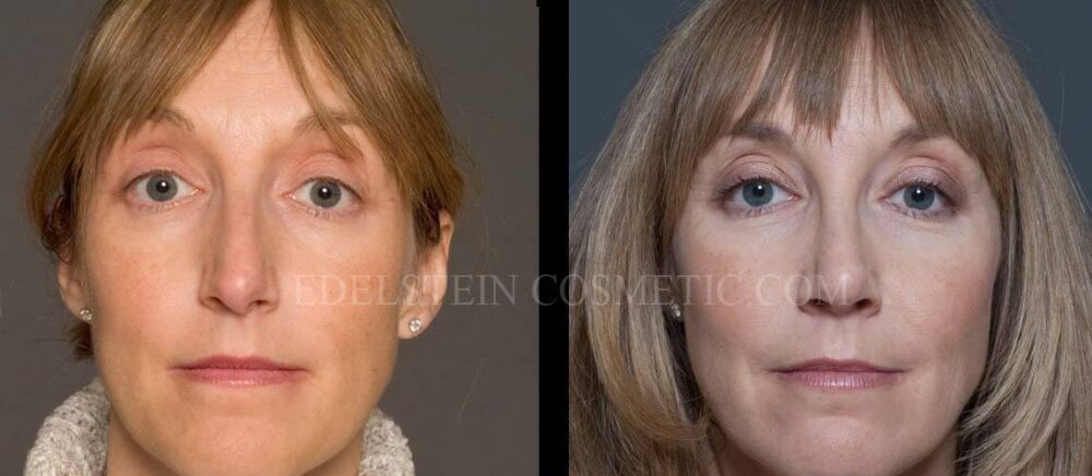 Primary Rhinoplasty case #26768