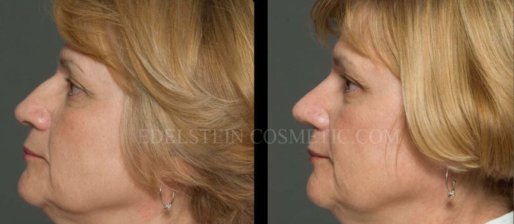 Primary Rhinoplasty case #26771