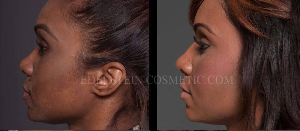 Primary Rhinoplasty case #26779