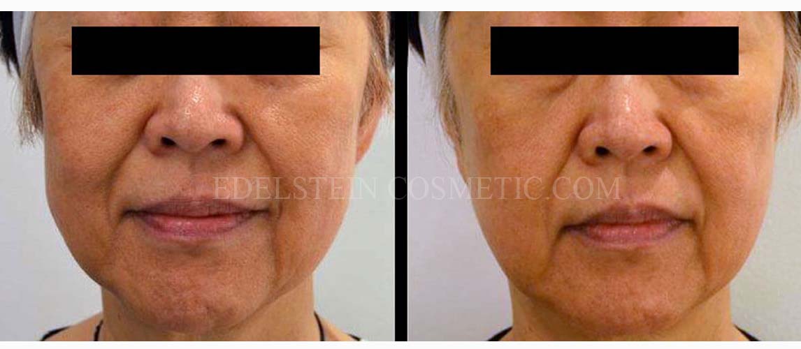 Refirme Skin Tightening case #26749