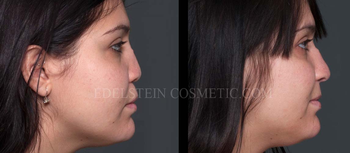 Reconstructive Rhinoplasty case #26800