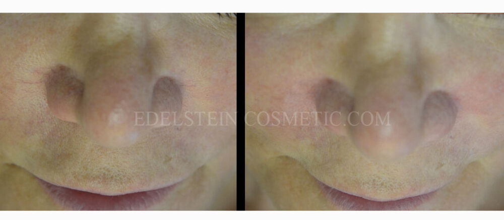 Spider Vein Removal case #26752