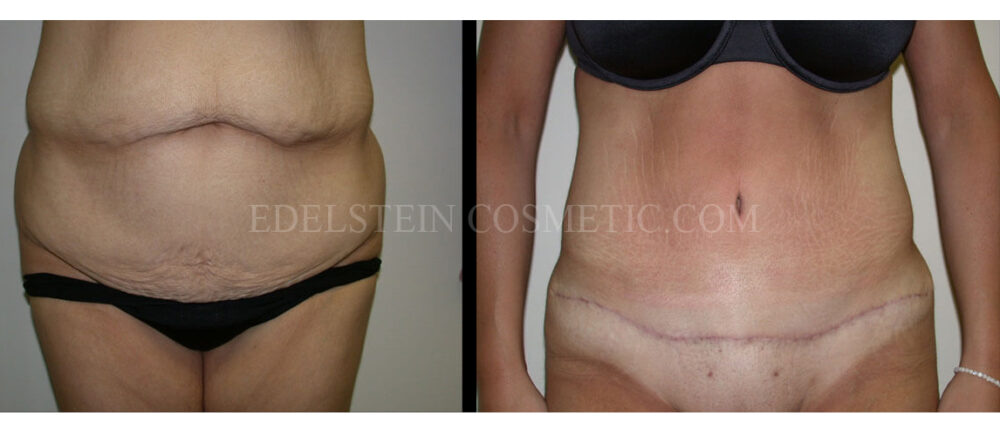 Tummy Tuck case #26638