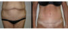 Tummy Tuck case #26638 slider thumbnail