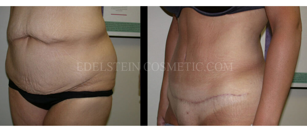 Tummy Tuck case #26638