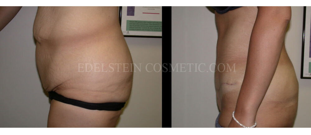 Tummy Tuck case #26638