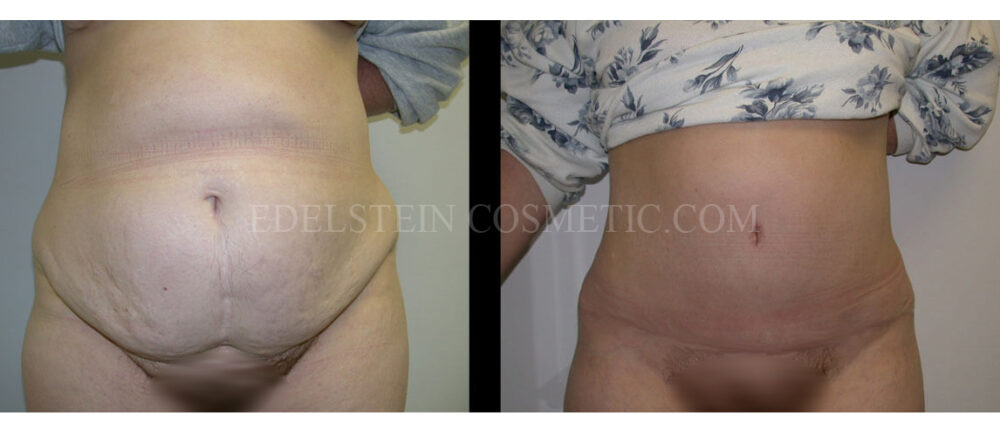 Tummy Tuck case #26637