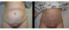 Tummy Tuck case #26637 slider thumbnail