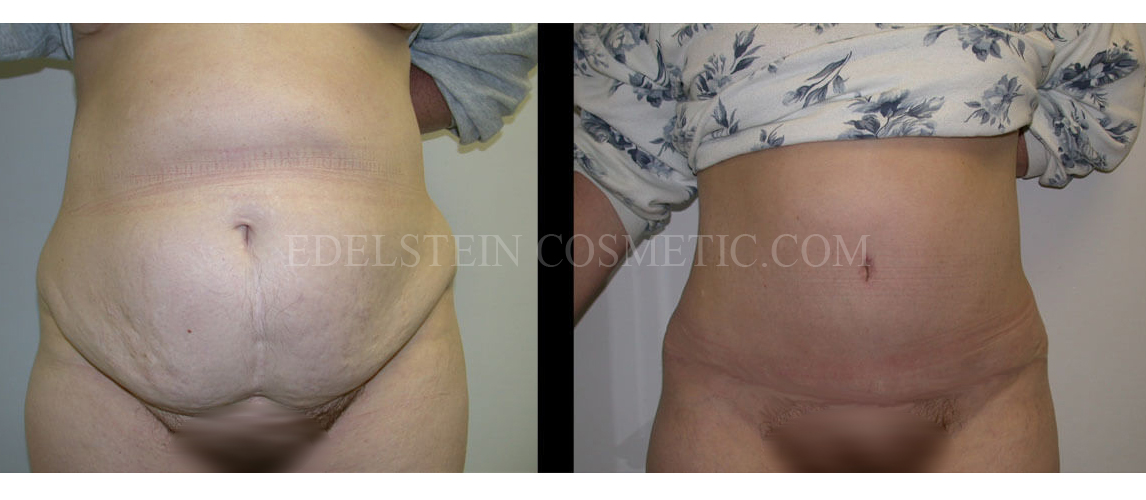 tummy-tuck-toronto-before-after-p021