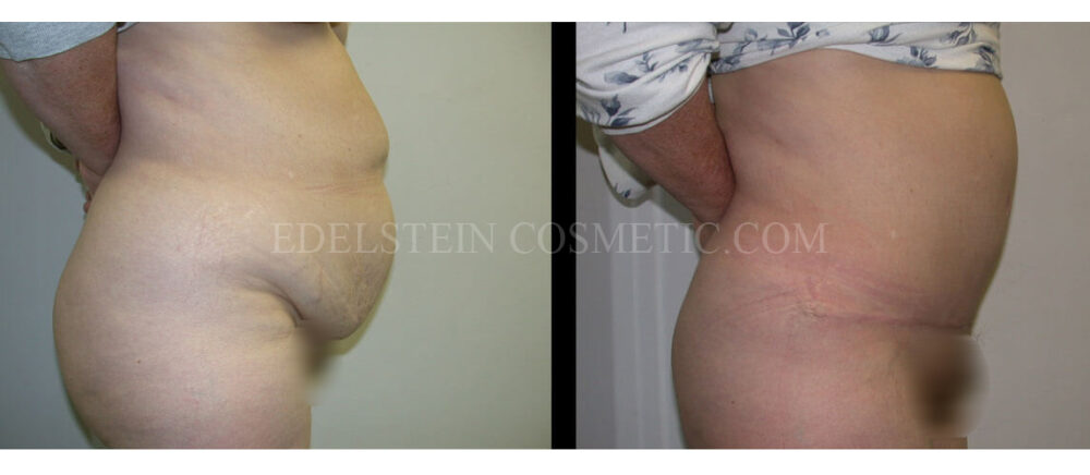 Tummy Tuck case #26637