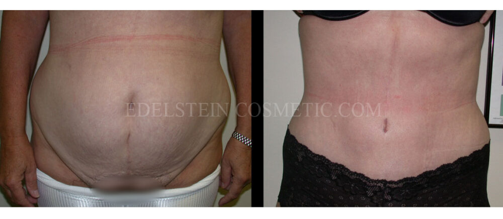 Tummy Tuck case #26636