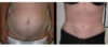 Tummy Tuck case #26636 slider thumbnail