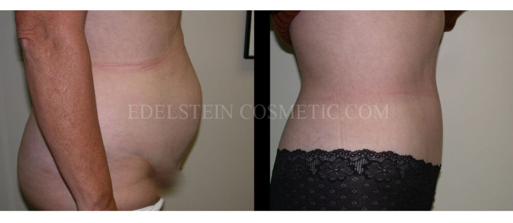 Tummy Tuck case #26636