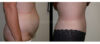 Tummy Tuck case #26636 slider thumbnail