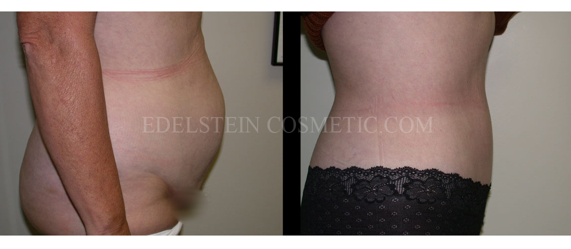 tummy-tuck-toronto-before-after-p03a1