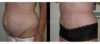 Tummy Tuck case #26636 slider thumbnail