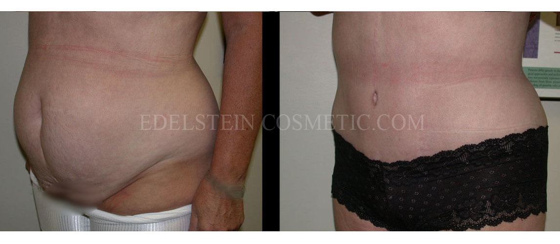 Tummy Tuck case #26636