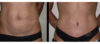 Tummy Tuck case #26635 slider thumbnail