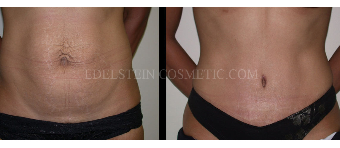 Tummy Tuck case #26635