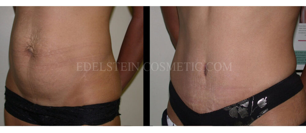 Tummy Tuck case #26635