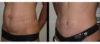 Tummy Tuck case #26635 slider thumbnail