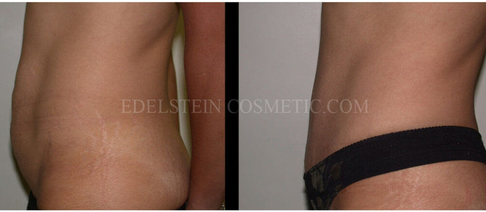 Tummy Tuck case #26635